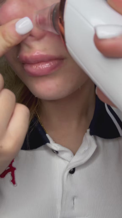 Blackhead remover