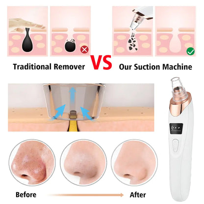 Blackhead remover